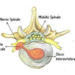 ernia-disco-2-150x150_CHIPOS_Jesi